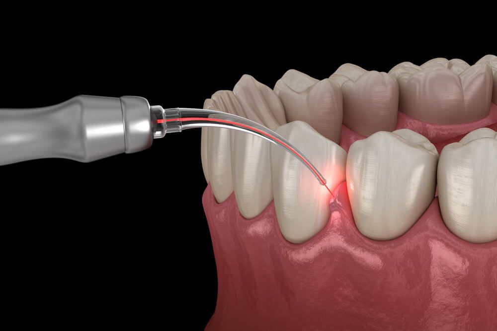 Laser Gum Treatment