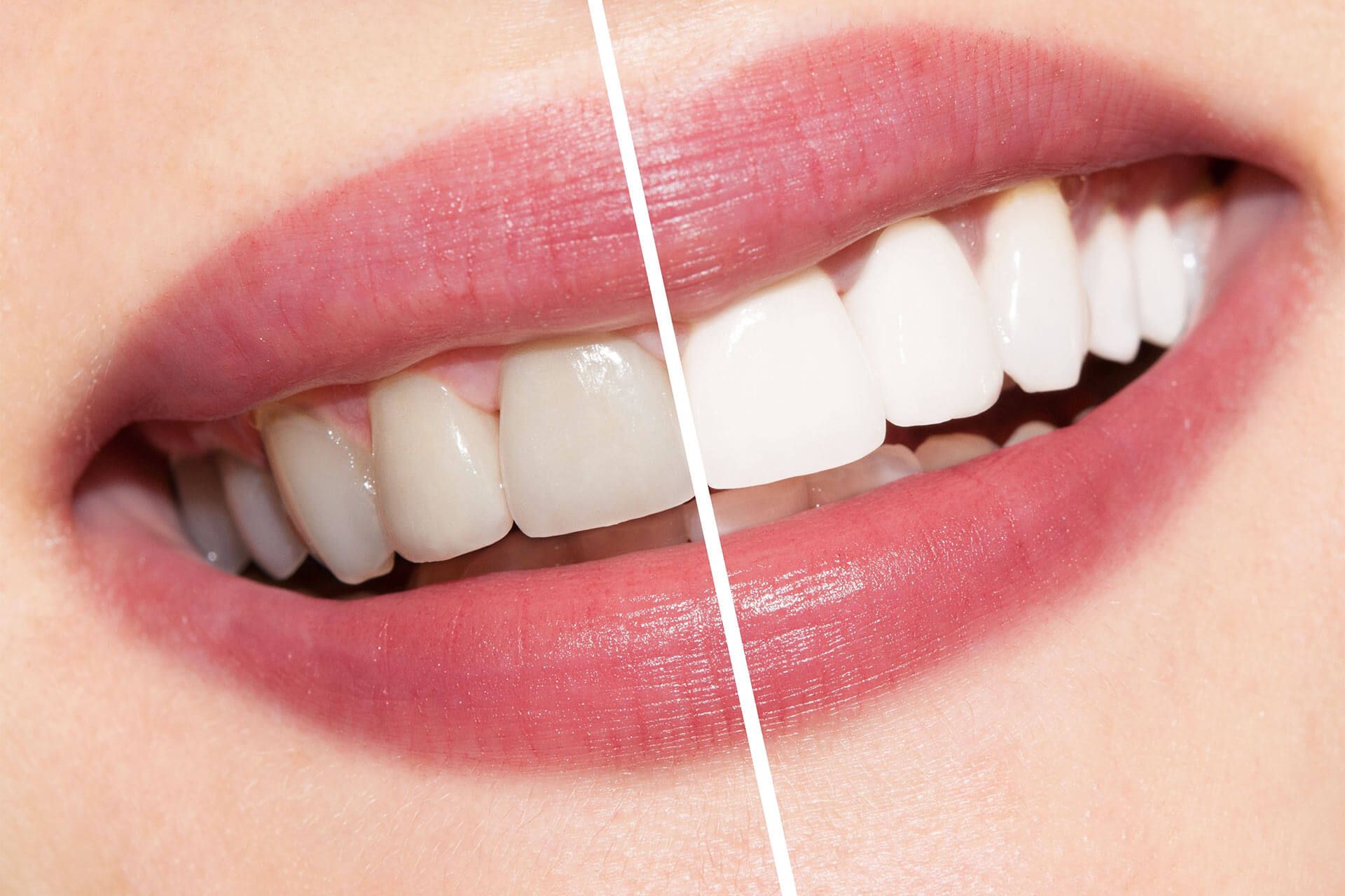 teeth whitening before and after